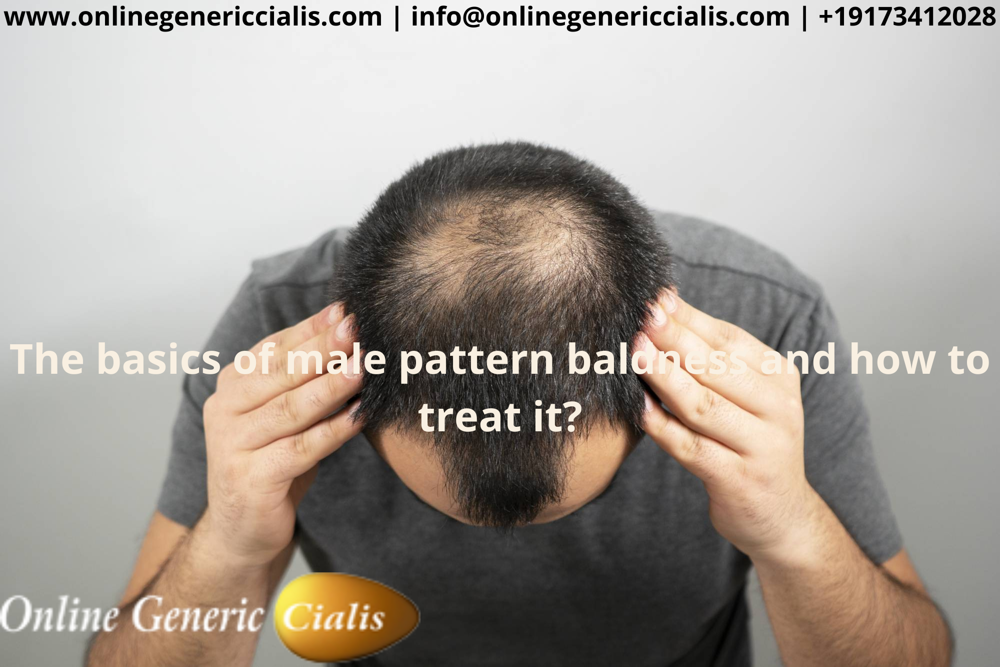 The basics of male pattern baldness and how to treat it?
